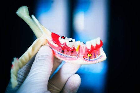 Téléchargez les photos : Dentistes carie dentaire modèle dentaire des dents, des gencives et du canal radiculaire - en image libre de droit