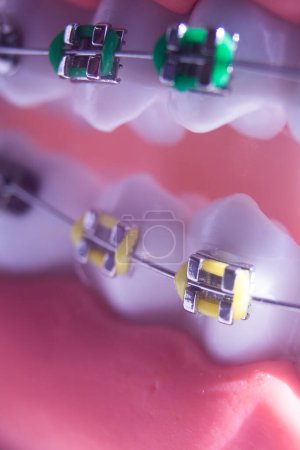 Téléchargez les photos : Supports métalliques modernes aligneurs redresseurs utilisés pour corriger l'alignement sur les dents par les dentistes. - en image libre de droit