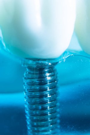 Téléchargez les photos : Modèle d'enseignement de la dentisterie par implant dentaire en métal montrant les dents et la gencive. - en image libre de droit