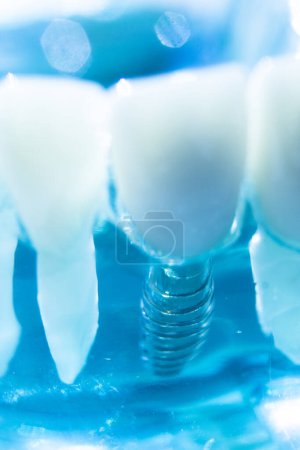 Téléchargez les photos : Modèle d'enseignement de la dentisterie par implant dentaire en métal montrant les dents et la gencive. - en image libre de droit