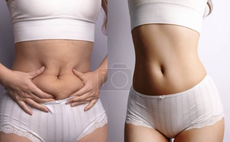 Before after excessive belly fat. Healthcare and woman diet lifestyle concept to reduce belly and shape up healthy stomach muscle. Cellulite.