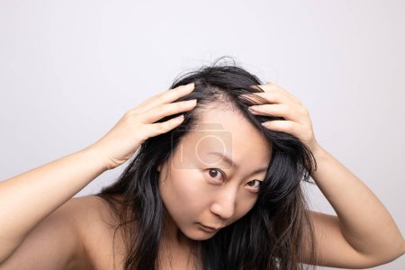 Photo for Asian woman serious hair loss problem for health care shampoo and beauty product concept - Royalty Free Image