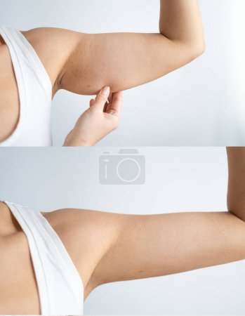 Foto de Se muestran los resultados antes y después de una operación de braquioplastia, también llamada levantamiento de brazos.. - Imagen libre de derechos