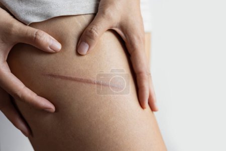 Weibliches Bein mit thermischen Verbrennungen der Haut. Häusliche Verletzungen beim Bügeln oder Kochen. Narben an den Beinen der Frau.