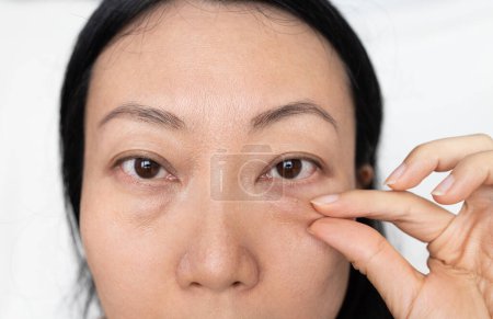 Photo for Asian Woman With Under Eye Bag. Puffy Eye Of Girl Showing Eyes Bags. - Royalty Free Image