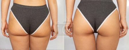 Gros plan des fesses féminines avec cellulite avant et après traitement isolé sur fond blanc. Se débarrasser de l'excès de poids, l'alimentation, une alimentation saine, l'entraînement, le sport, le massage, le gommage. Bien-être