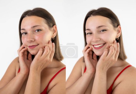 Téléchargez les photos : Avant et après le traitement au laser de la rosacée, l'acné. Intervention réussie. traitement de l'acné procédure. Concept de soins de la peau. Jeune femme avec problème d'acné avant et après le traitement sur fond blanc. - en image libre de droit