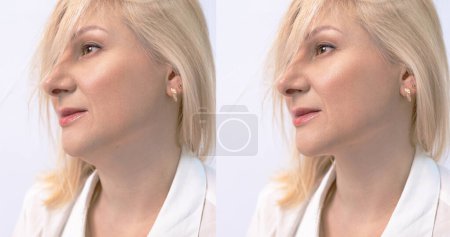 Téléchargez les photos : Double menton féminin avant et après correction. Correction de la forme du menton liposuccion du cou. Le résultat de l'intervention en clinique de médecine esthétique. - en image libre de droit