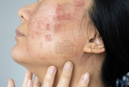 Téléchargez les photos : Cicatrice sur le visage d'une femme à la suite d'un traitement au laser. Le concept de beauté et de traitement de la peau. - en image libre de droit