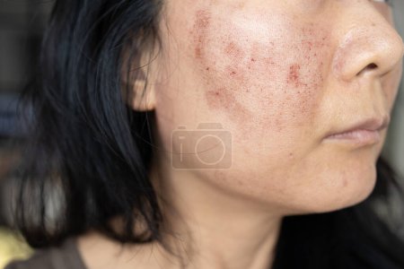 Foto de Una cara de mujer asiática que se sometió a un tratamiento facial con láser de Co2 para tratar sus cicatrices de acné para conseguir una cara suave. Láser puede resolver este problema - Imagen libre de derechos