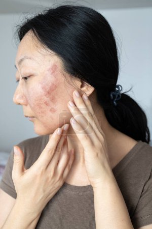 Téléchargez les photos : Un visage de femme asiatique qui avait traitement de la peau du visage par laser Co2 pour traiter ses cicatrices d'acné pour obtenir visage lisse. Laser peut résoudre ce problème - en image libre de droit