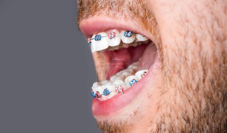 Close to the teeth braces on the white teeth of man to equalize the teeth. Bracket system in smiling mouth, macro photo teeth, close-up lips, macro shot, dentist. Man with braces.