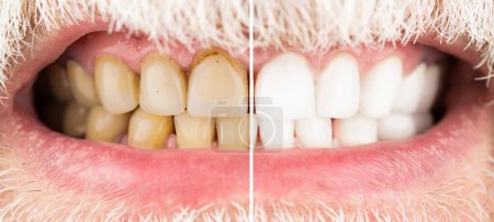 Foto de Dientes masculinos antes y después del blanqueamiento, odontología, estomatología. Hombre sonriente antes y después del procedimiento de blanqueamiento de dientes, primer plano. - Imagen libre de derechos