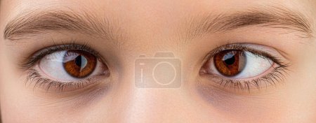 Strabismus. Little patient strabismus, treatment ophthalmic diseases. Strabismus in children causes, treatment concept. Female eyes with strabismus.