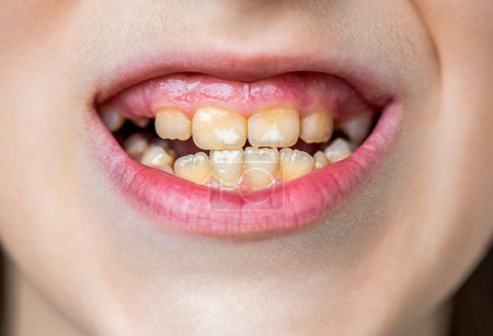 Primer plano de los dientes de bebé poco saludables. Boca abierta de un niño pequeño con dientes mal crecidos de cerca. El concepto de ortodoncia y estomatología. Dientes malos niño. Retrato chico con mal diente.