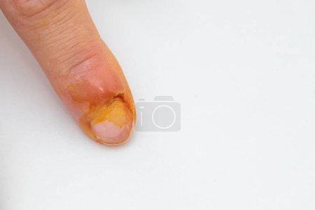 Photo for Inflammation of the finger. Close up. - Royalty Free Image