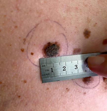 Measuring the size of a mole on human skin.