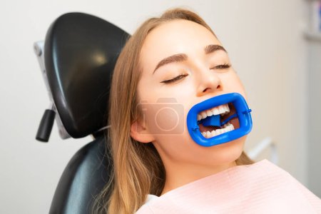 Un retractor de puntal bucal o abridor de labios en la boca de la mujer para el procedimiento de blanqueamiento de dientes.