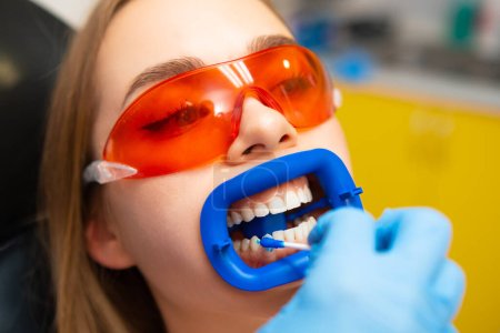 Téléchargez les photos : Le dentiste applique un gel blanchissant sur la patiente, portant des lunettes de protection orange, des dents dans la clinique dentaire - en image libre de droit