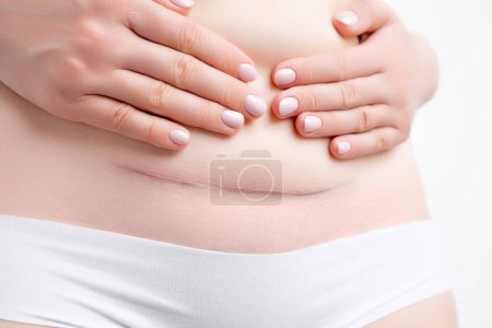 Photo for Woman holding her belly and demonstrates hypertrophic scar after c section. - Royalty Free Image