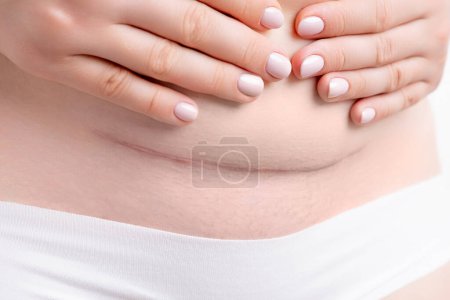Photo for Woman belly with a big scar from a cesarean section. - Royalty Free Image