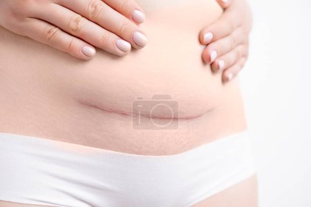 Photo for Woman belly with a scar from a cesarean section on the white background. - Royalty Free Image