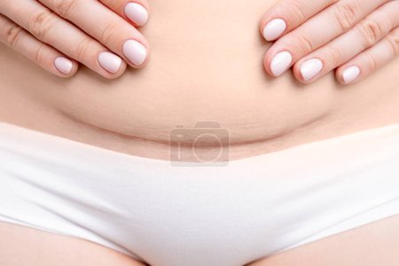 Photo for Close up womans belly with scar after C section. - Royalty Free Image