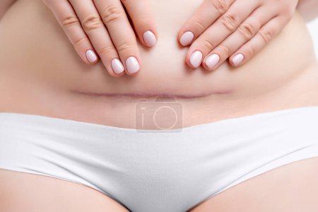 Photo for Close up a woman belly keloid scar after c section. - Royalty Free Image