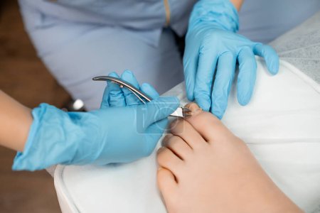 Podologe entfernt eingewachsenen Zehennagel in Klinik mit Zangenschneider. 