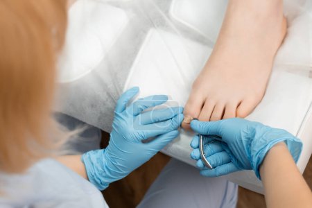 Close up of a pedicure master is cutting and removing ingrown toenail on a female foot in a nail salon.