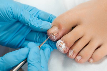 Podologist in blue gloves doing medical treatment on female toes in medical center.