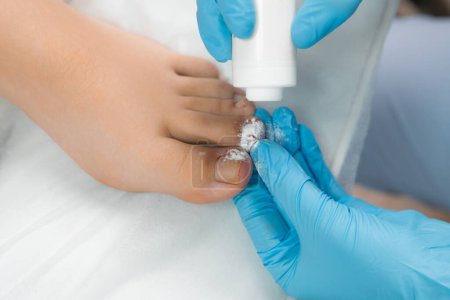 Después de la extirpación de uñas, el podólogo espolvorea un polvo antiséptico en la zona del dedo del pie