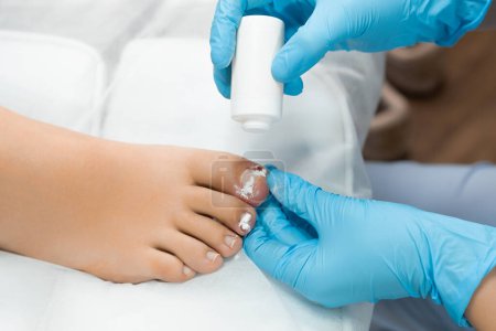  Después de extirpar la uña, el podólogo aplica un antiséptico en polvo en el dedo del pie para la desinfección.