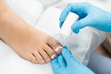 El especialista del pie administra un desinfectante polvoriento en el dedo del pie después de la extracción de la uña.