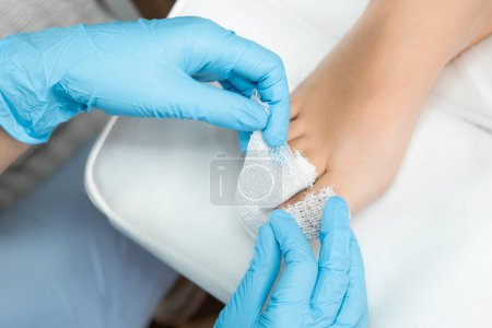 Podologe verwendet einen Verband, um nach der Nagelentfernung Antiseptikum auf den Zeh aufzutragen. 