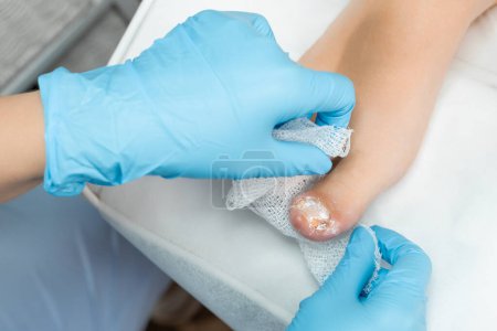 Podologist applies a powdery antiseptic to the toe after removing the nail. 