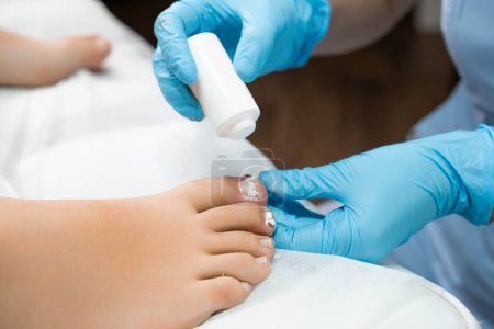 Aplicación de antibióticos en polvo en las uñas de los pies por podólogo en la clínica. 