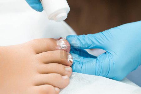 Antibiotic powder is used for treating various fungal or bacterial infections on the toenails by podologist in the clinic