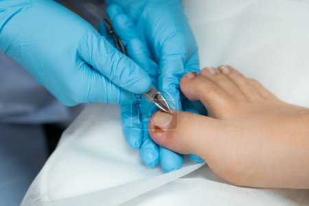  Un podólogo realiza el procedimiento de extirpación de uñas encarnadas utilizando pinzas. 
