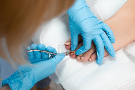 Paciente en procedimiento de pedicura médica y tratamiento de la enfermedad de las uñas en la clínica.