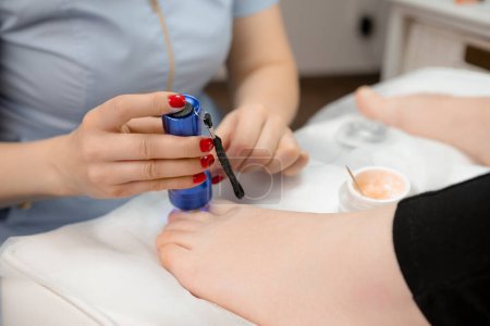 Podiatrist applies a titanium thread to a toenail and employs a UV lamp