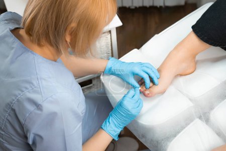 Top view of female podiatrist performs the procedure of ingrown nail removal.