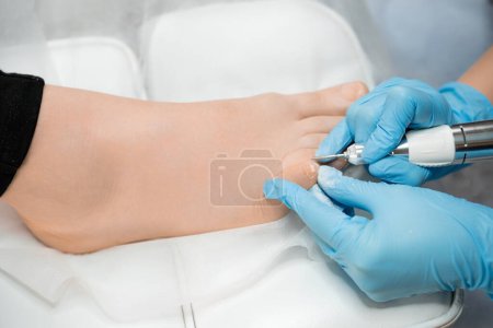 Téléchargez les photos : Une séance de pédicure médicale implique un podiatre traitant l'ongle de l'orteil à l'aide d'une fraiseuse. - en image libre de droit