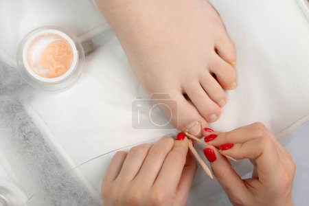 A podologist puts a titanium thread on a toenail for woman, top view