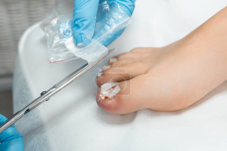 Close up podiatrist applies a bandage after an ingrown toenail removal procedure. 