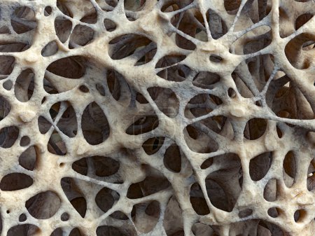 Estructura esponjosa ósea realista de primer plano, textura ósea afectada por la osteoporosis, ilustración 3D. Tejido óseo dañado por osteoporosis