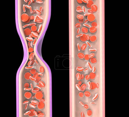 Obstructed vein due to thrombosis and normal vein with blood cells. 3D rendering