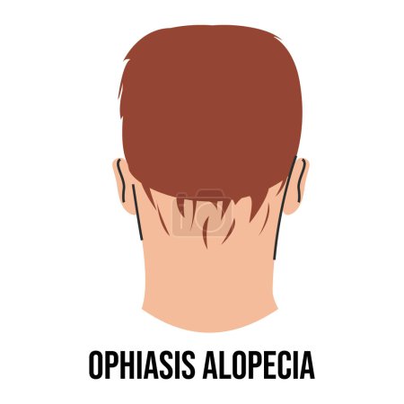 Illustration for Ophiasis alopecia vector isolated. Male and female character suffering from hair loss. Problems with health. Medical condition. - Royalty Free Image