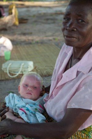 Téléchargez les photos : Xai Xai Mozambique : Se concentrer sur la petite fille albinos aux yeux bleus tenue par une femme plus âgée assise à l'ombre d'un arbre pour protéger l'albinos de la lumière du soleil en raison du manque de mélanine dans sa peau - en image libre de droit