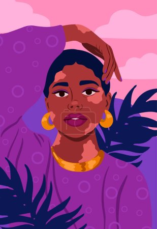 Illustration for Portrait of a beautiful woman with vitiligo. Self love and body concept - Royalty Free Image